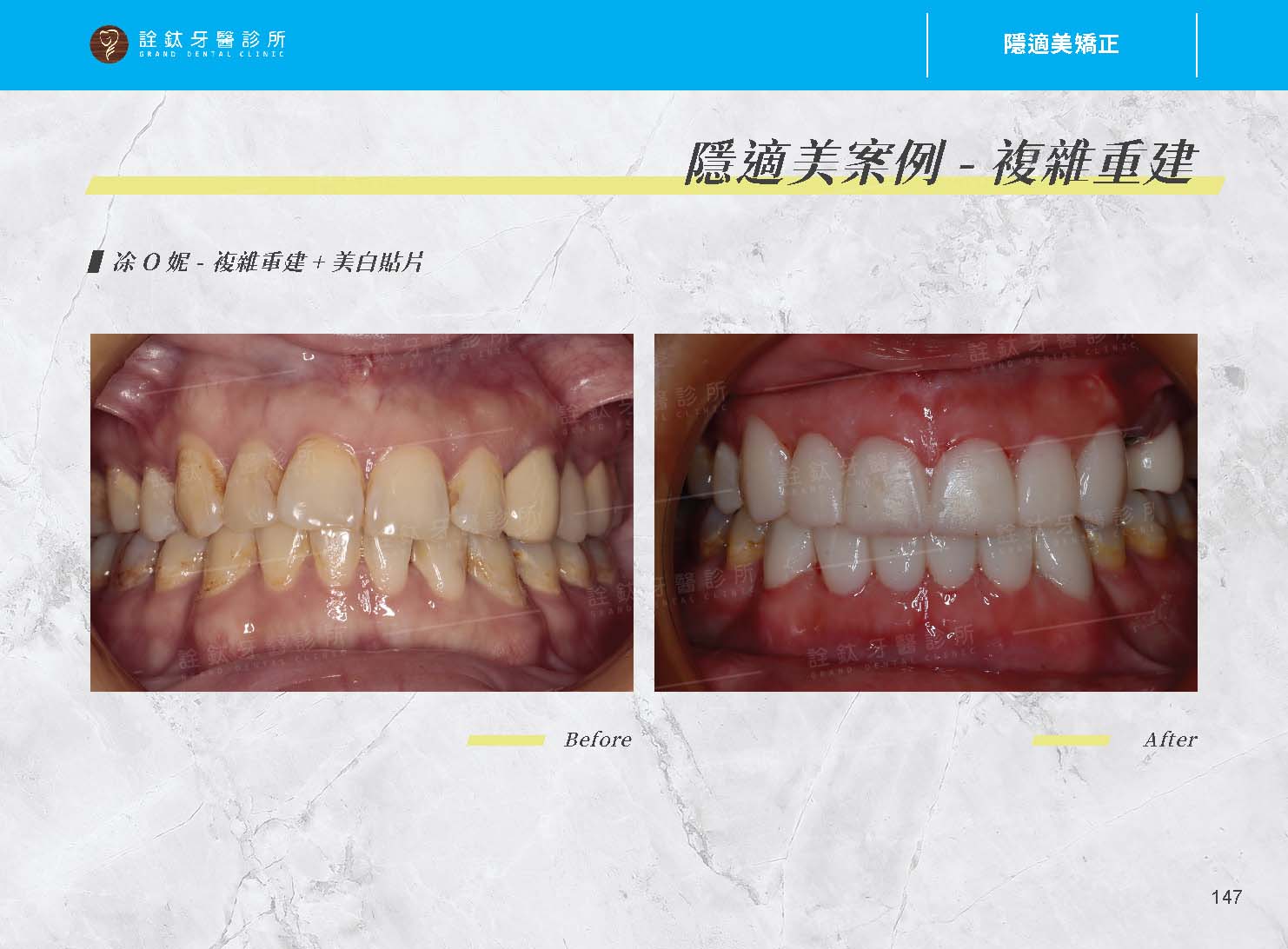 隱適美矯正 隱適美矯正