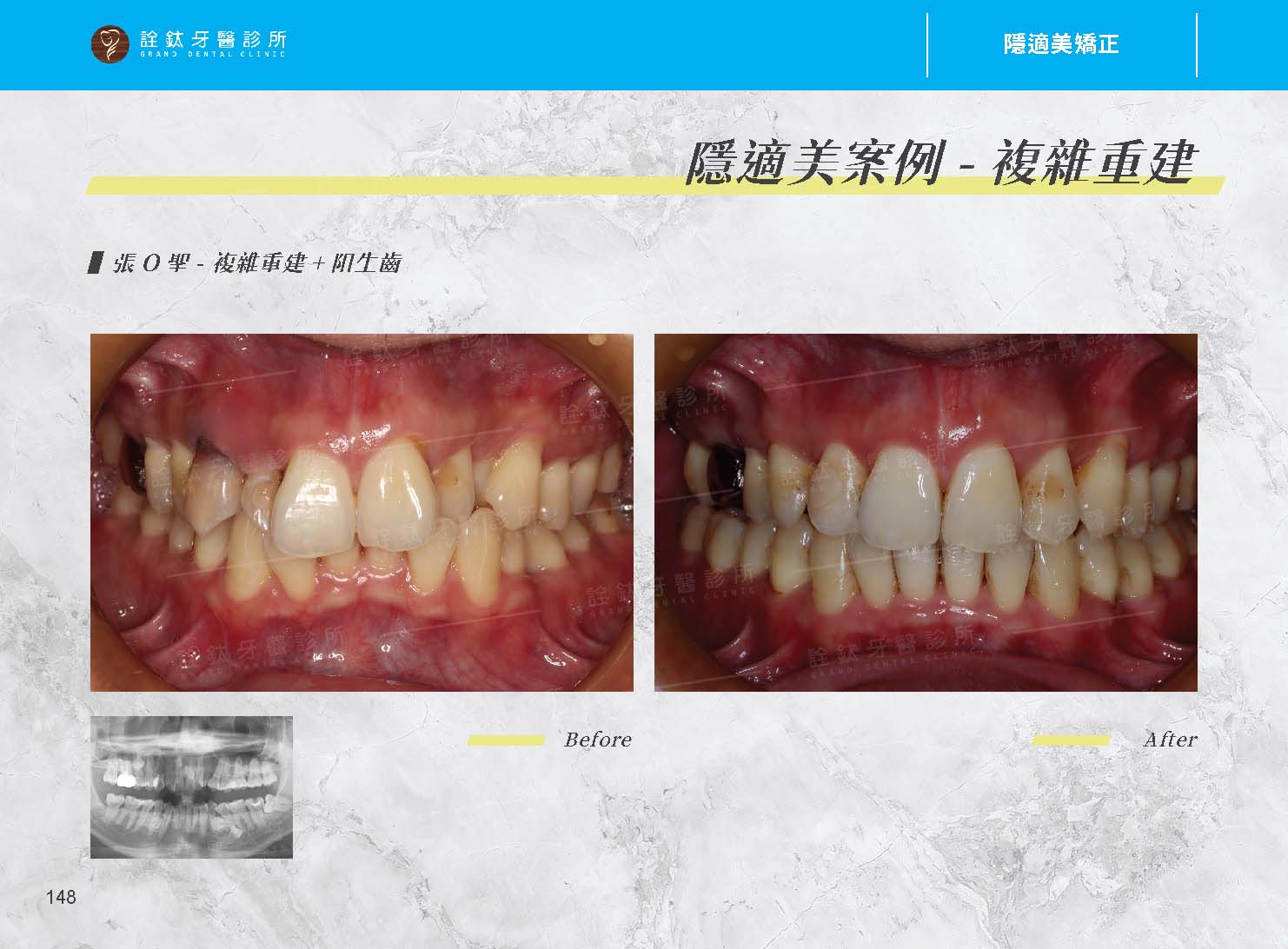 隱適美矯正 隱適美矯正
