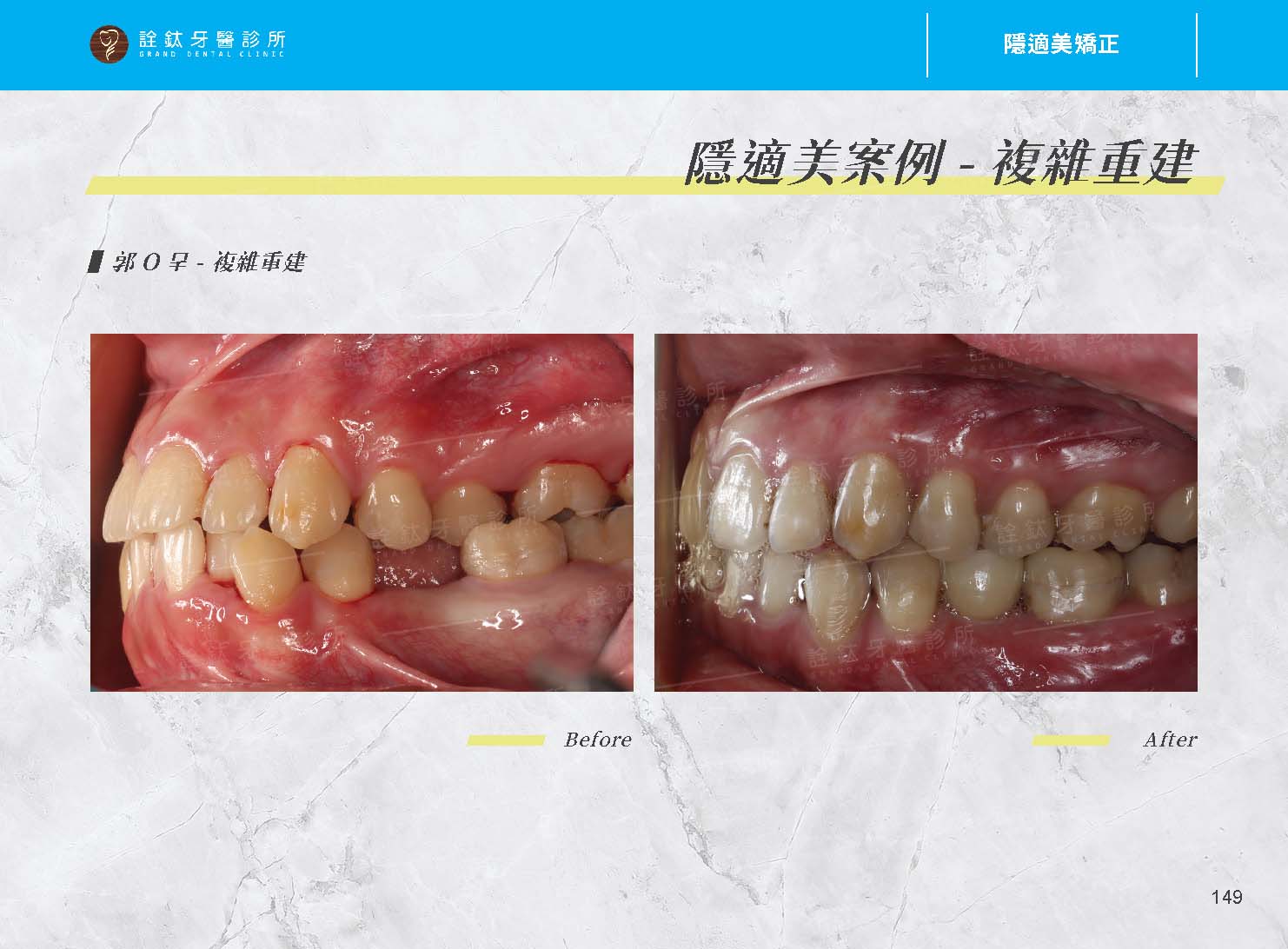 隱適美矯正 隱適美矯正
