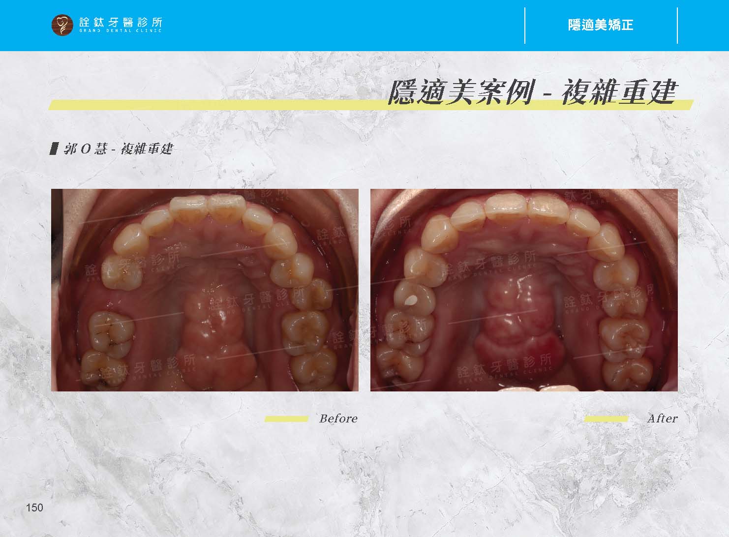 隱適美矯正 隱適美矯正
