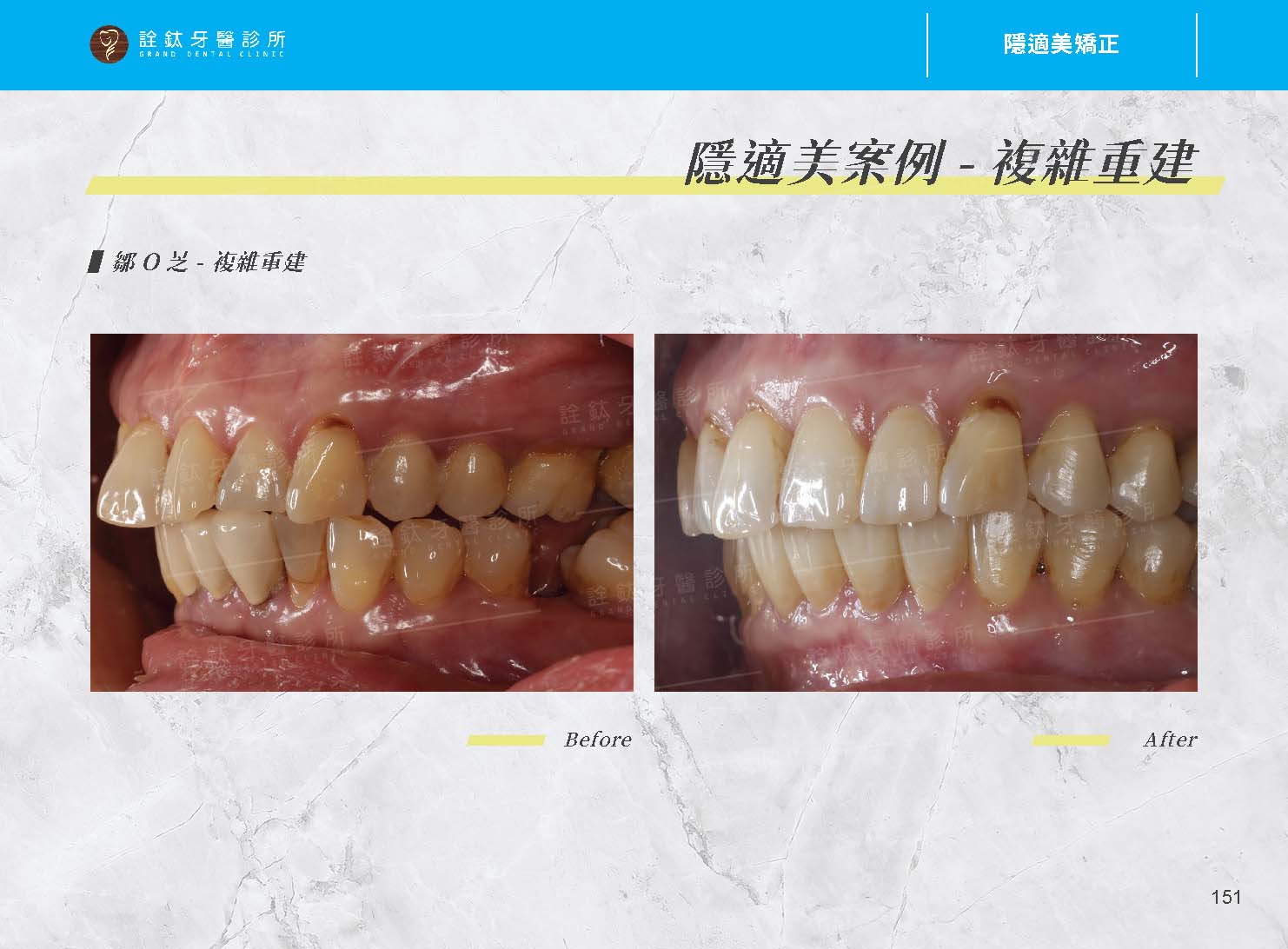 隱適美矯正 隱適美矯正