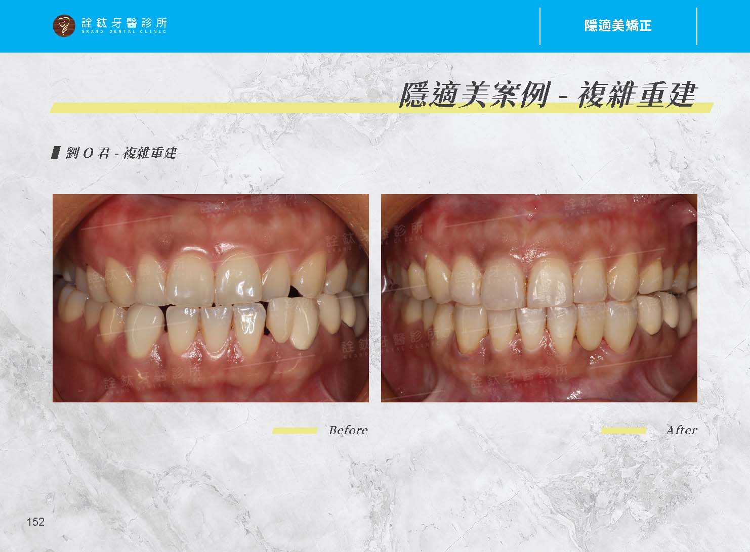 隱適美矯正 隱適美矯正