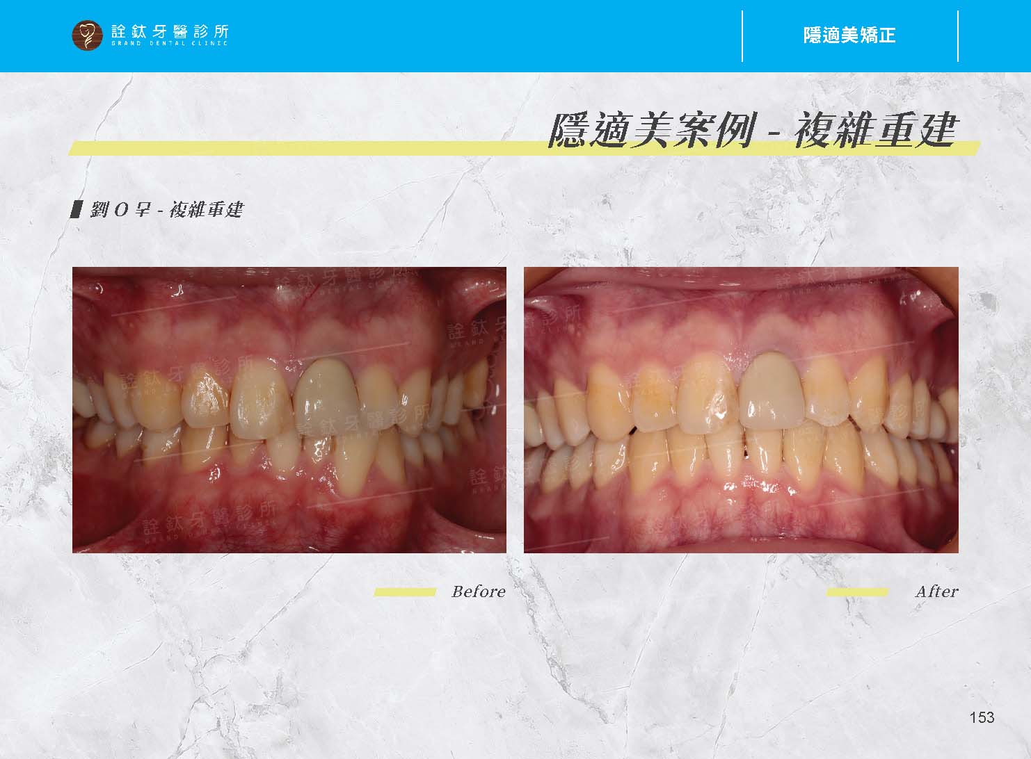 隱適美矯正 隱適美矯正