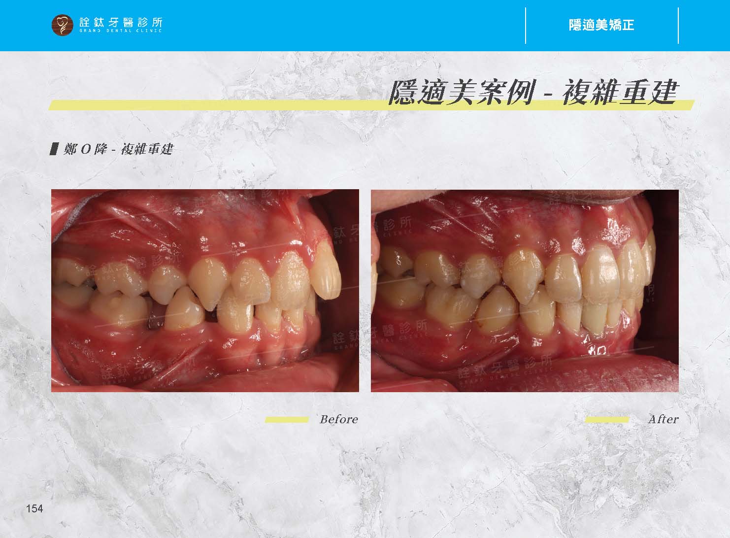 隱適美矯正 隱適美矯正