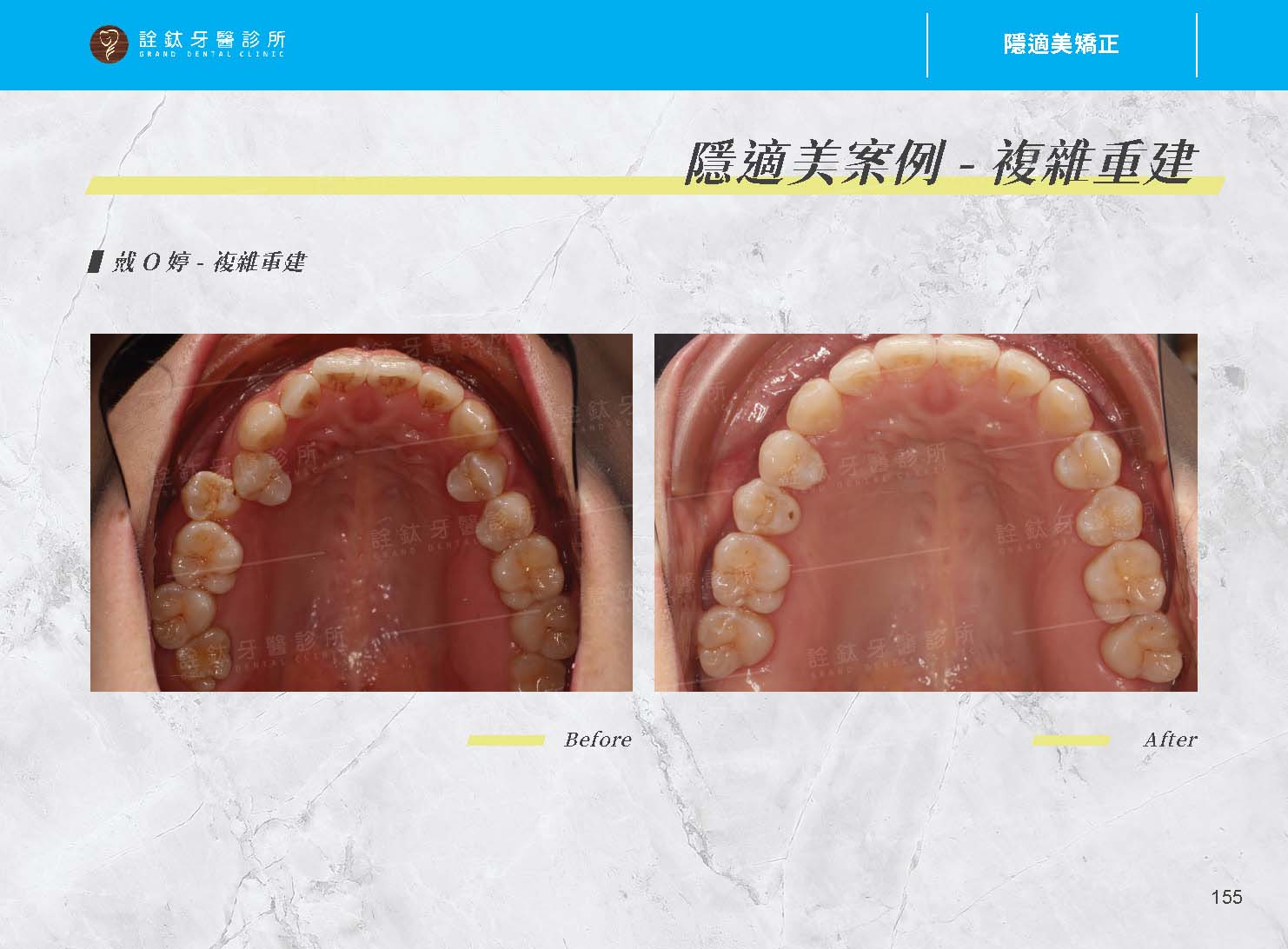 隱適美矯正 隱適美矯正