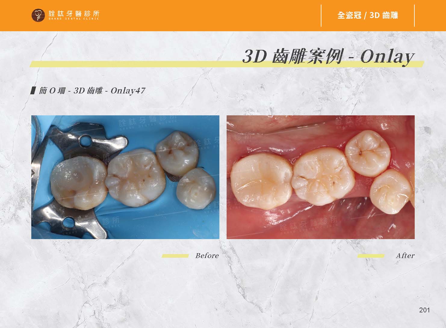 嵌體 （3D齒雕）