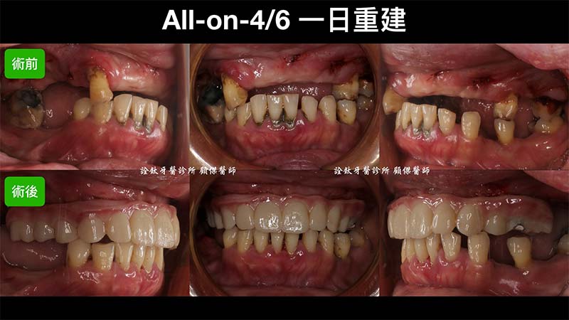 一日重建(All on 4/5/6) 一日重建(All on 4/5/6)