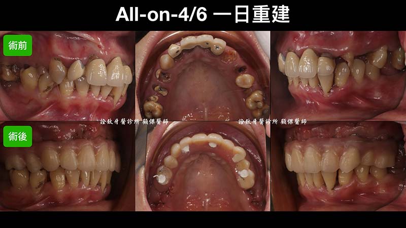 一日重建(All on 4/5/6) 一日重建(All on 4/5/6)