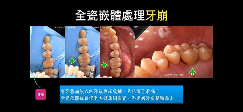 嵌體 (3D齒雕) 嵌體 (3D齒雕)