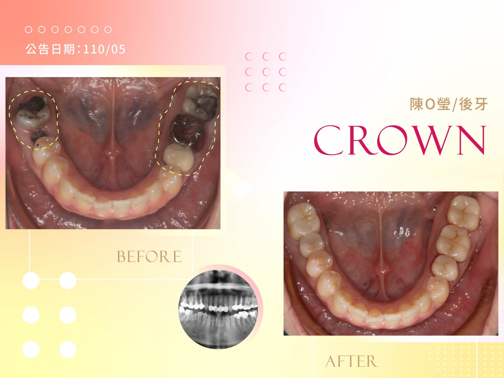 超仿真全瓷牙冠 超仿真全瓷牙冠