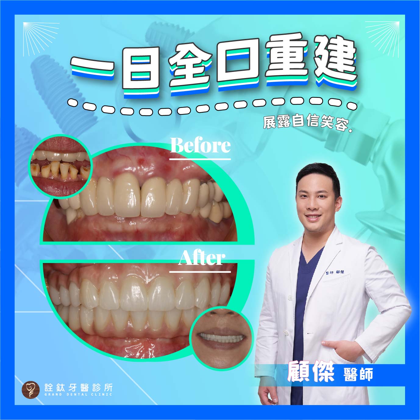 All-on-4與數位微笑設計?