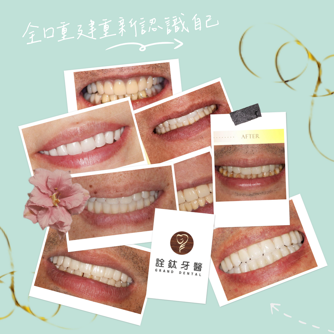 透過全口重建幫牙齒煥然一新吧✨