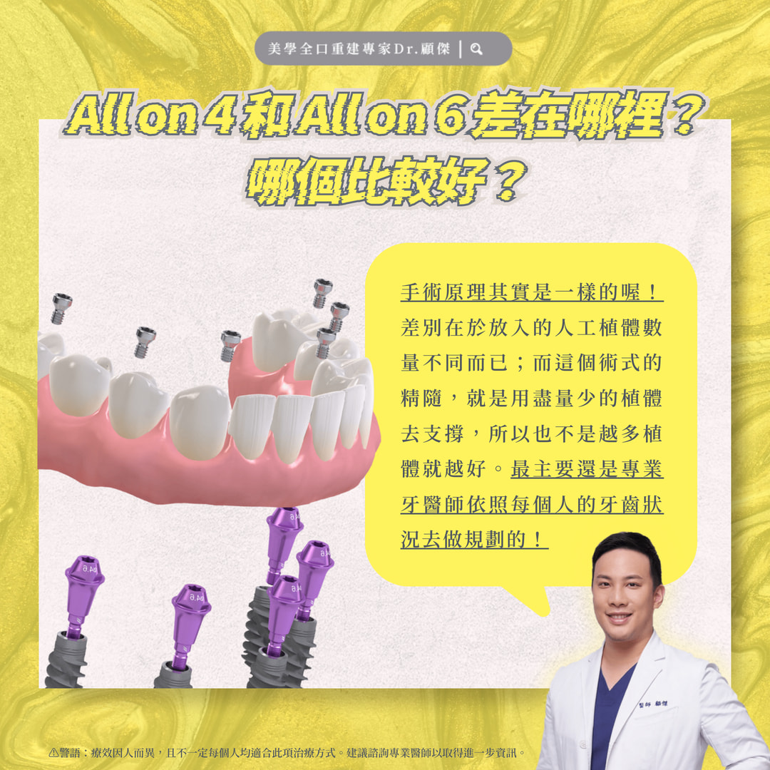 All on 4 和 All on 6 究竟差在哪裡？