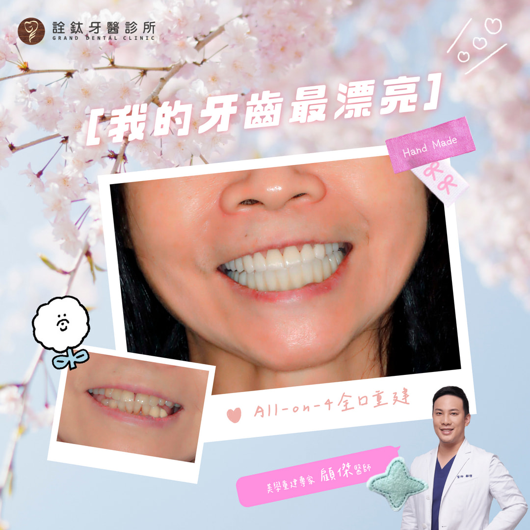 ? 我的牙齒最漂亮！All-on-4 全口重建案例分享 ?