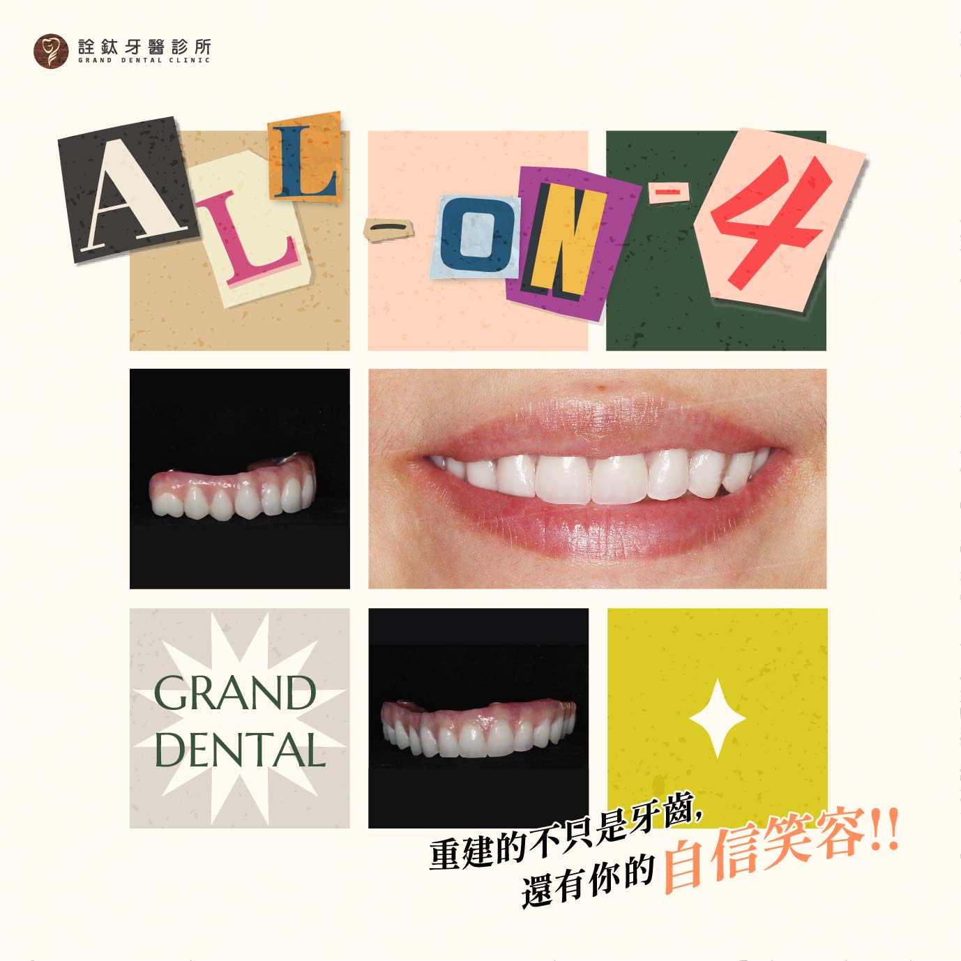 重建的不只是牙齒,還有自信美麗的笑容! 重建的不只是牙齒,還有自信美麗的笑容!