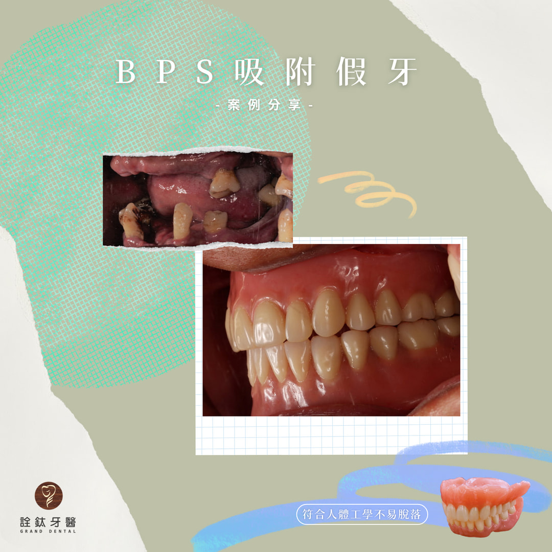【BPS吸附性假牙案例分享】