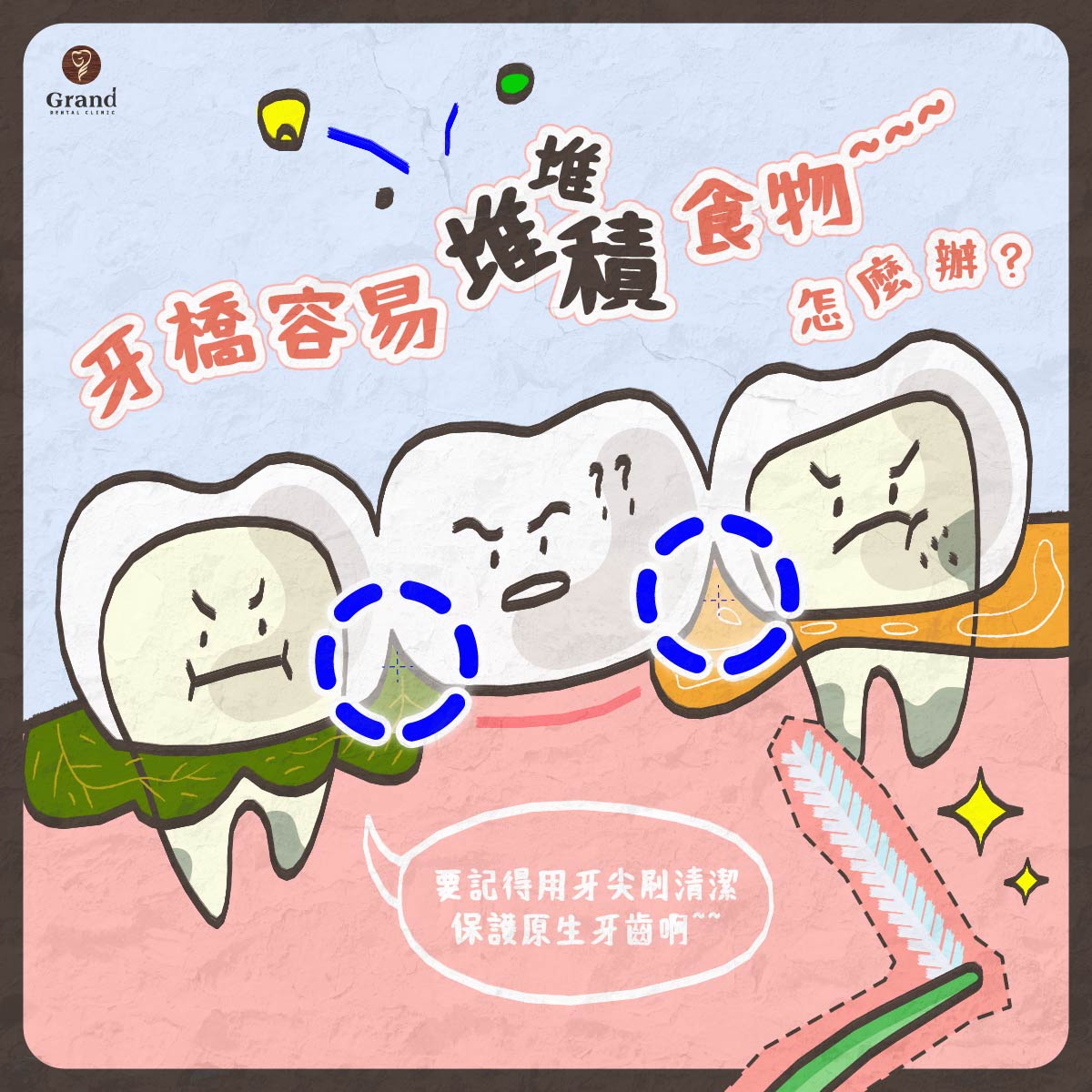 牙橋容易堆積食物怎麼辦?
