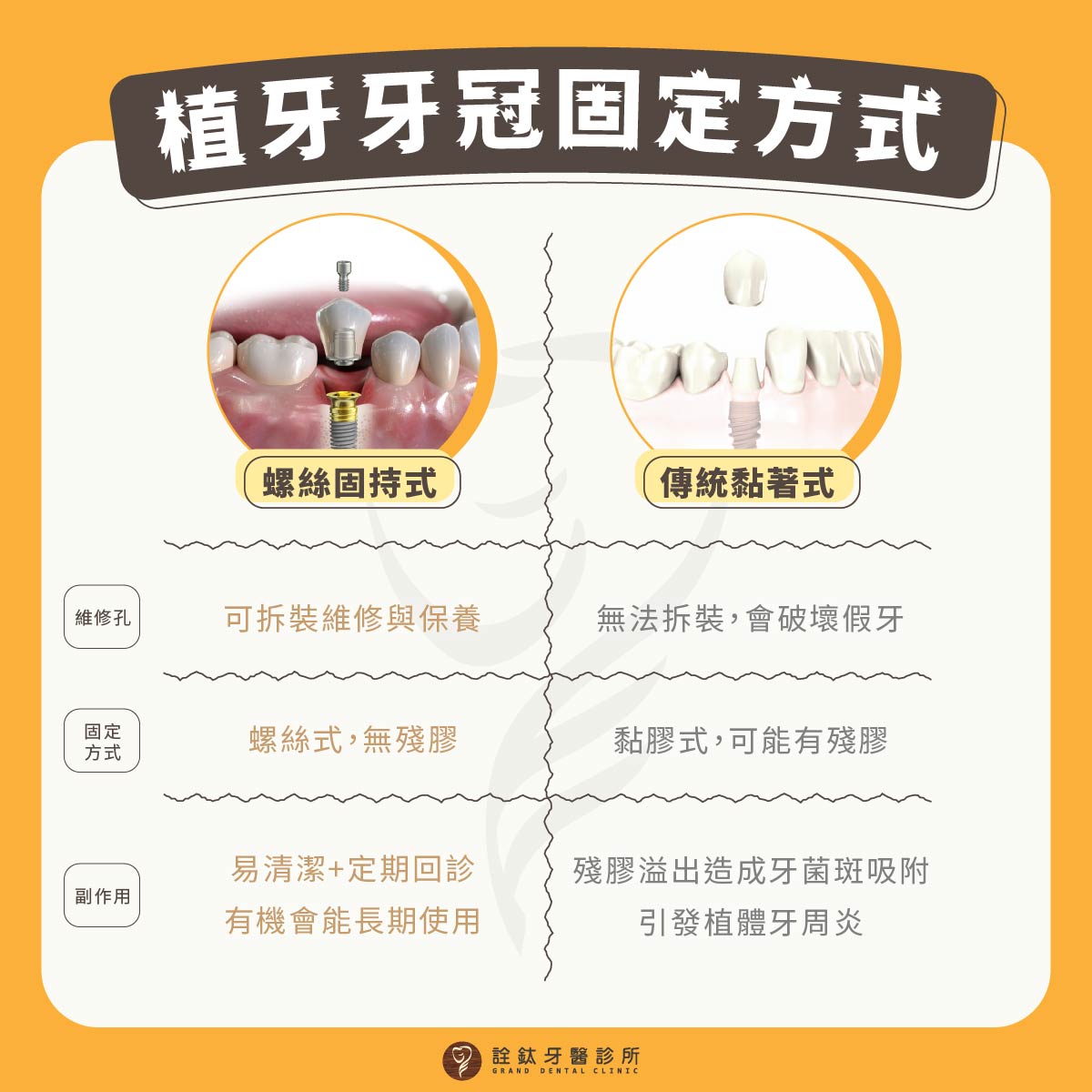 牙冠固定方式大不同?