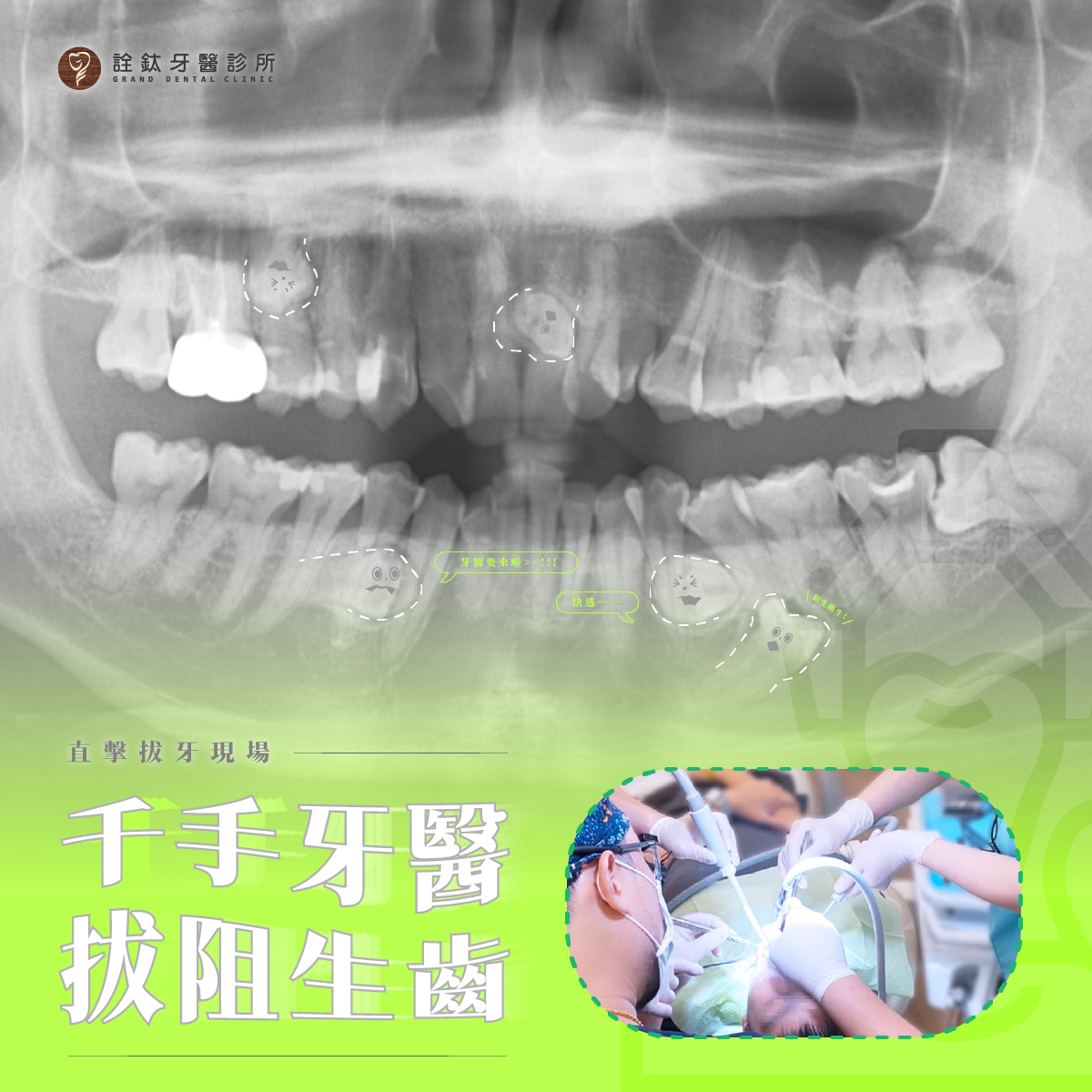 ?直擊千手牙醫與阻生齒戰鬥中