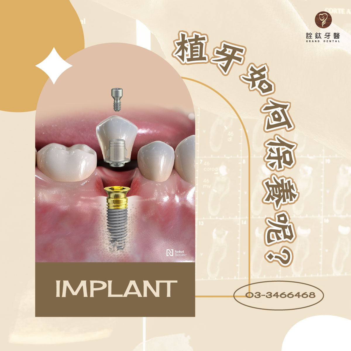 植牙要如何保養才好呢？