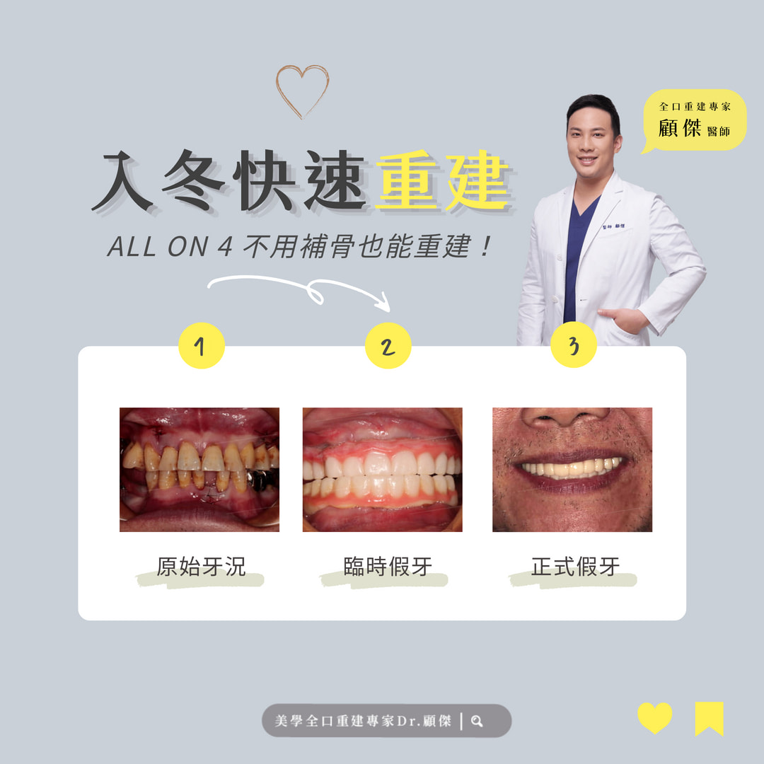 ? 入冬快速重建 - All on 4 不補骨也能輕鬆重建！ ?