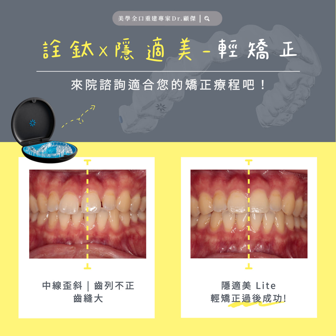 ✨ L先生的隱適美Lite矯正之旅