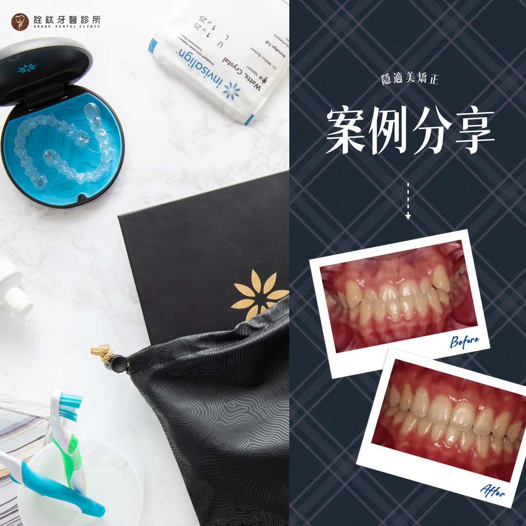 🦷 隱適美矯正案例分享｜L小姐