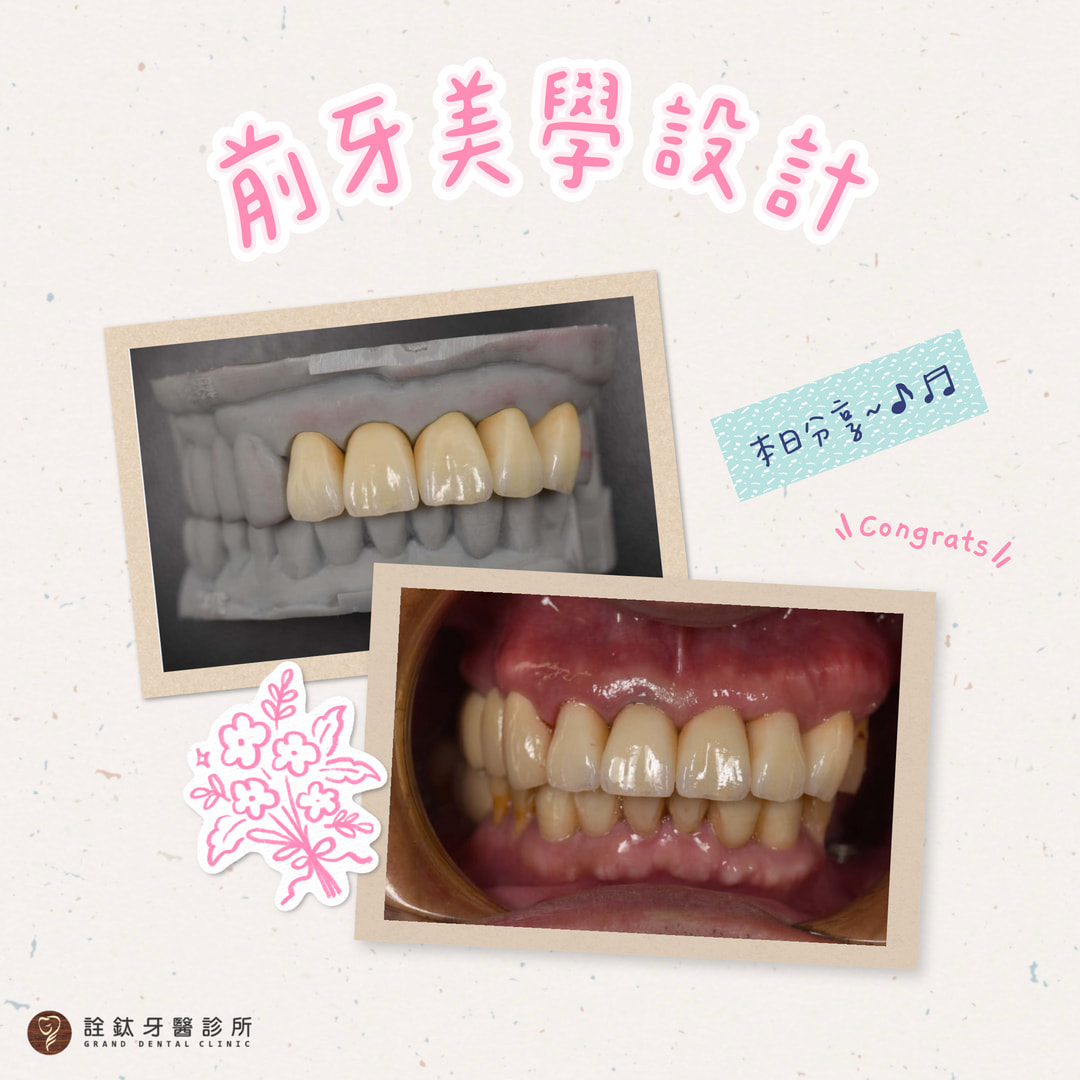 美學全瓷冠打造自然前牙