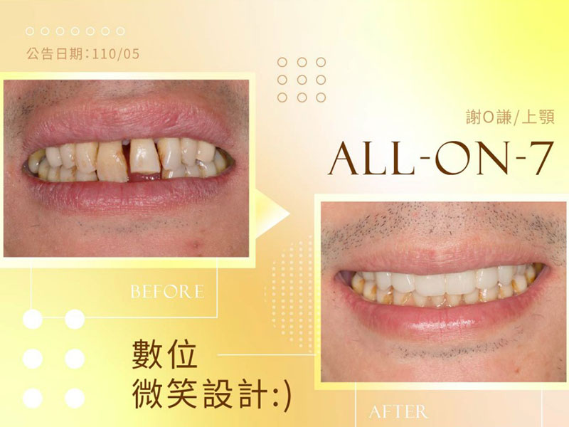 All-on-4 / All-on-6 All-on-4 / All-on-6