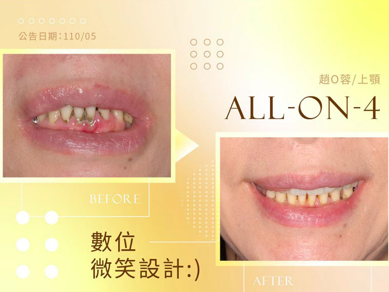 All-on-4 / All-on-6 All-on-4 / All-on-6