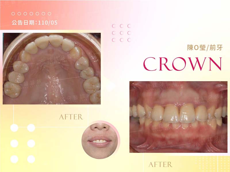 全瓷牙冠 全瓷牙冠