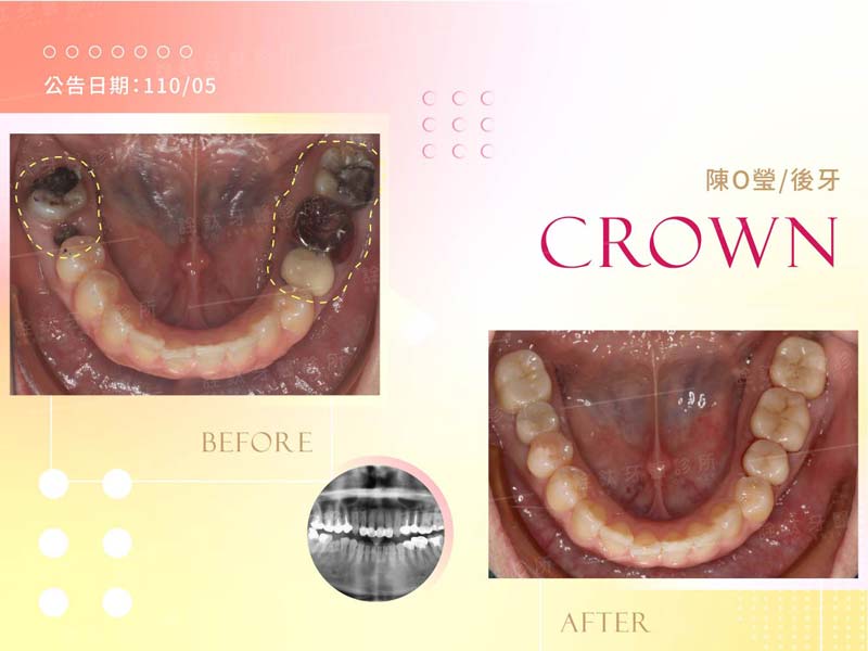 全瓷牙冠 全瓷牙冠