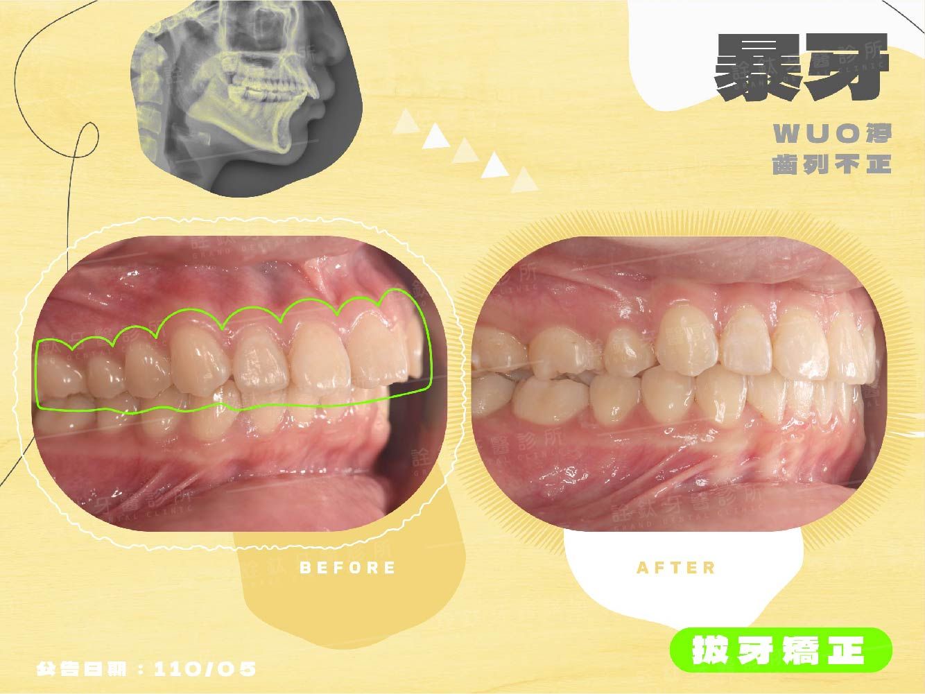 牙齒矯正 牙齒矯正
