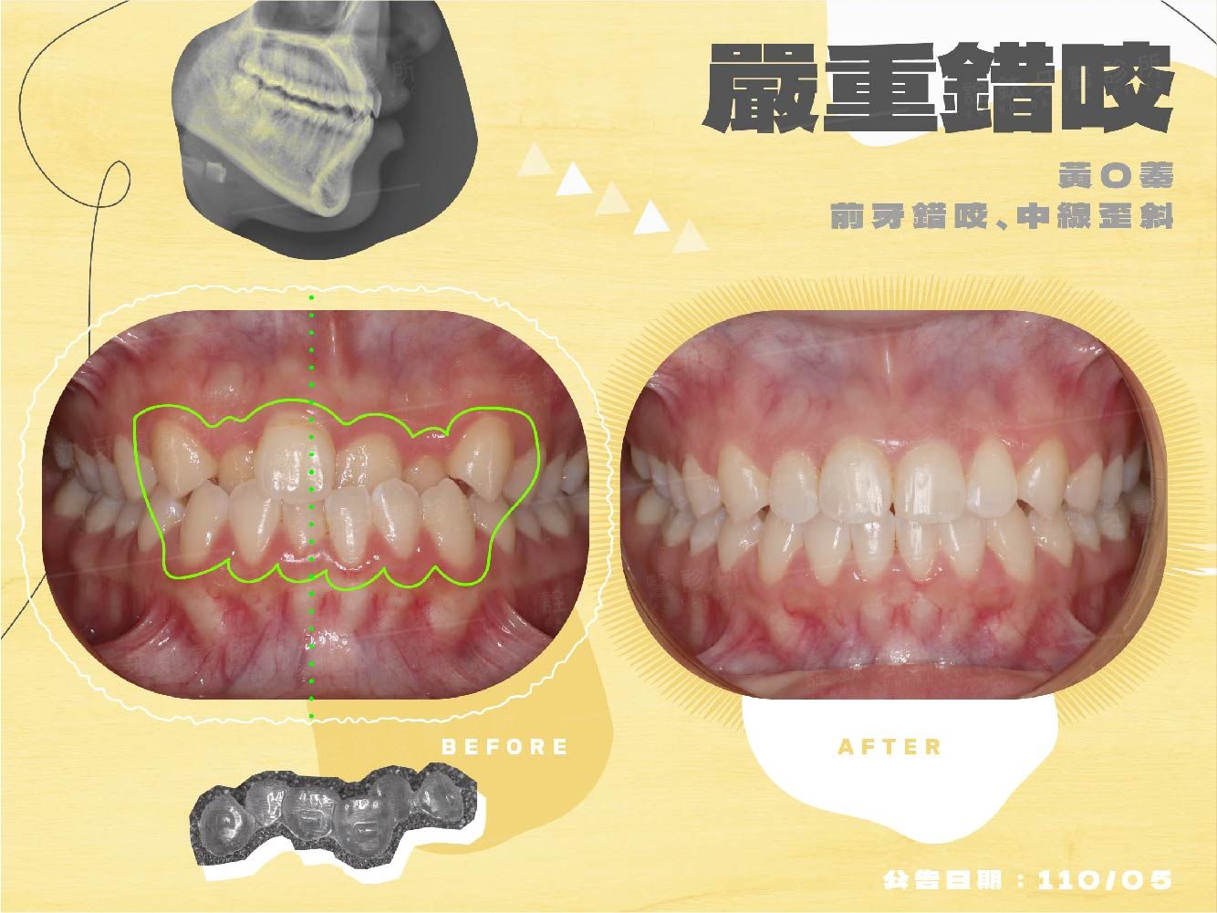 牙齒矯正 牙齒矯正
