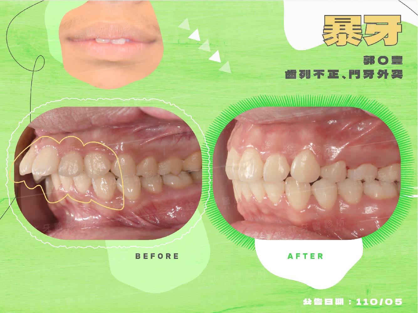 牙齒矯正 牙齒矯正