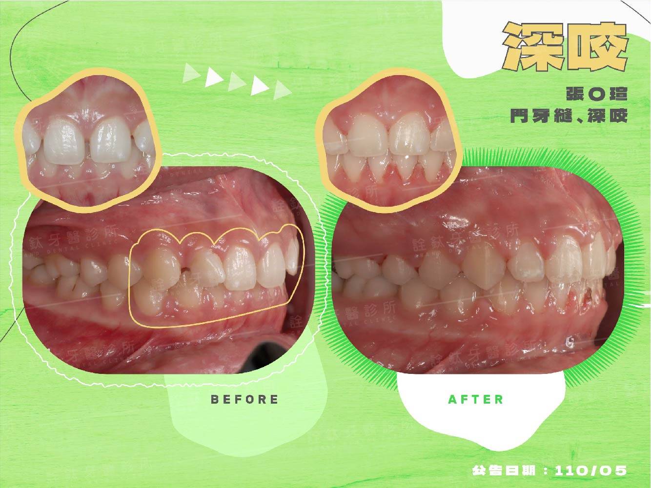 牙齒矯正 牙齒矯正