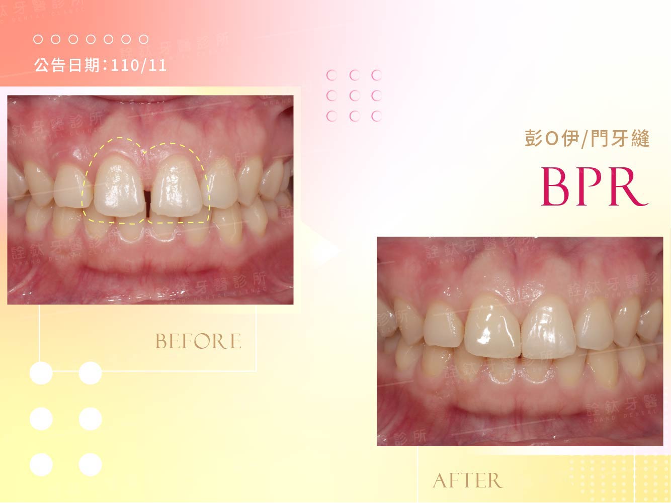 一日美齒 一日美齒