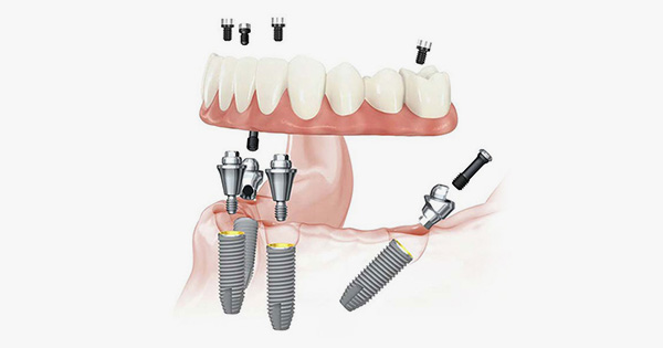 2025全口重建 All on 4，一日完成全口重建，5大指南告訴您