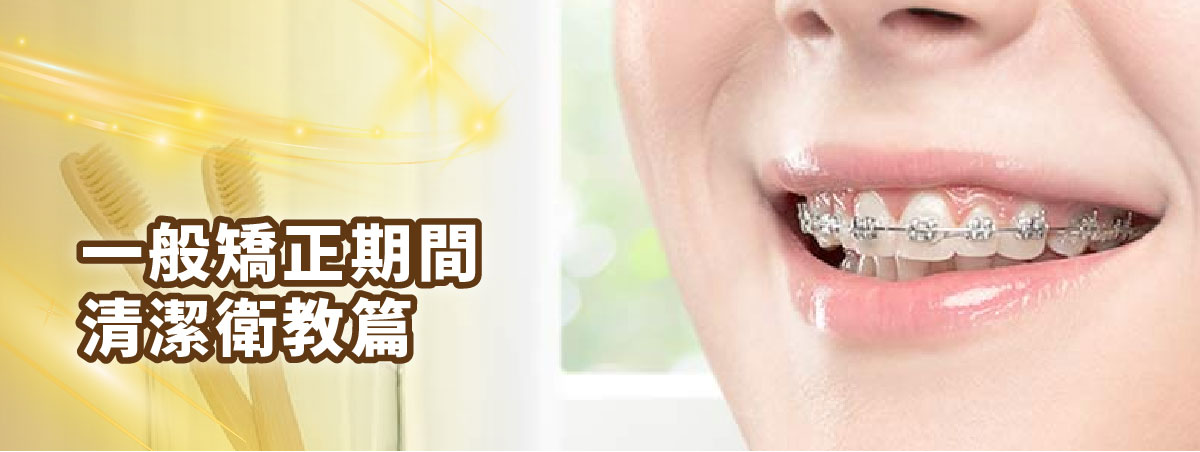 【一般矯正期間愛注意+清潔衛教篇】 【一般矯正期間愛注意+清潔衛教篇】