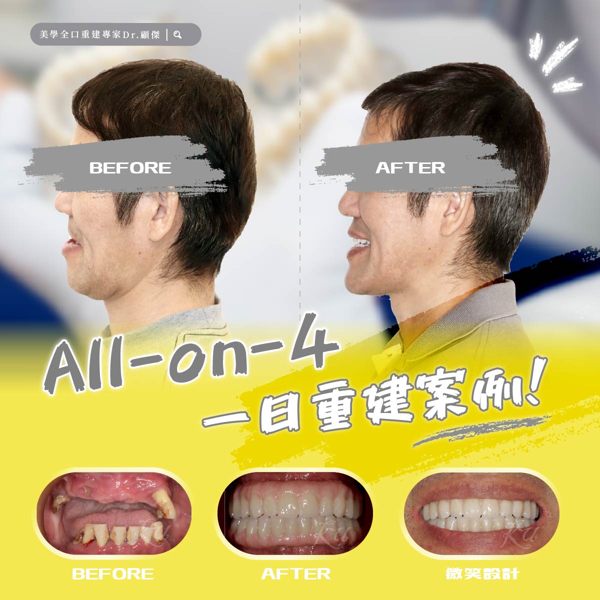 All-on-4全口重建，重拾大口吃美食的幸福時光