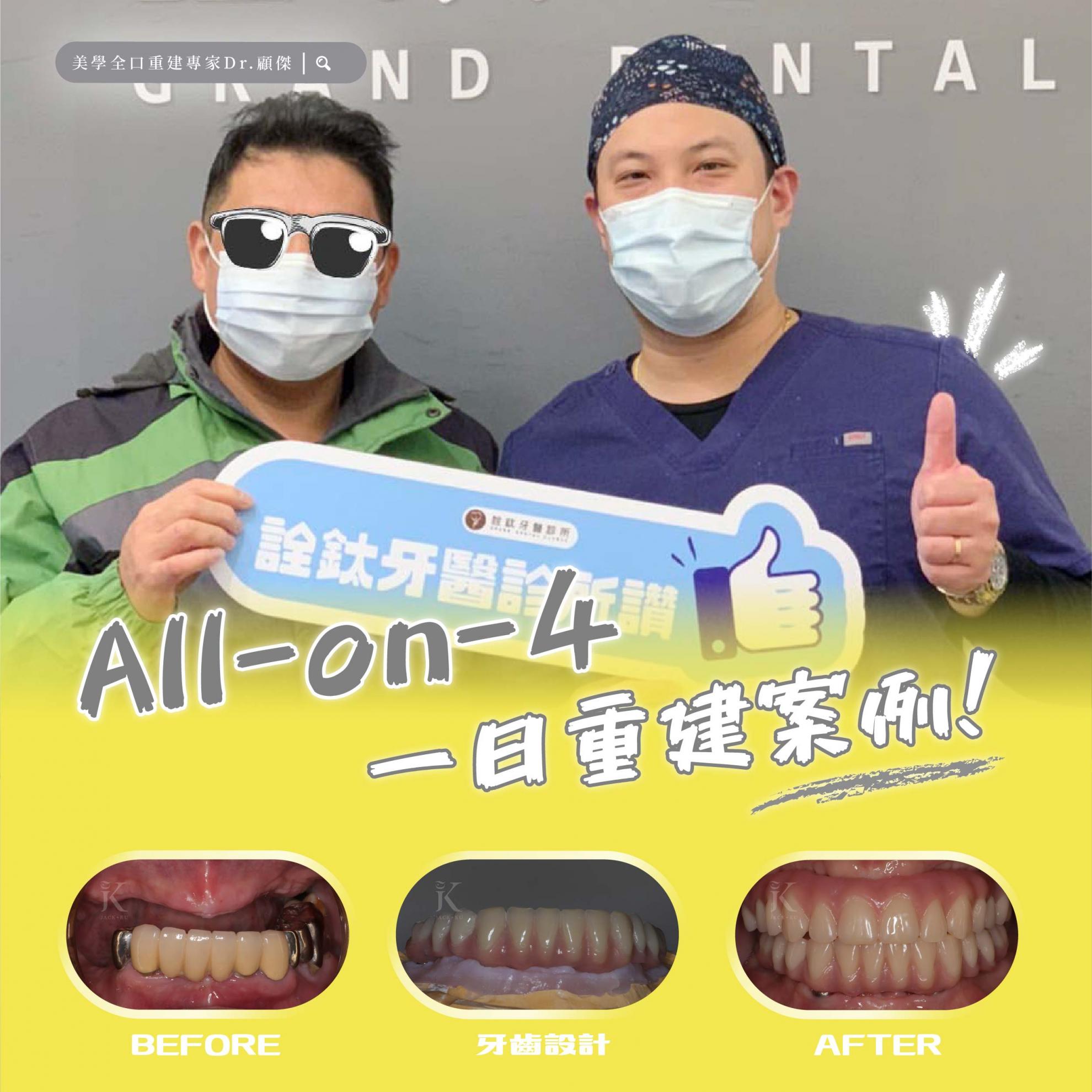 All-on-4全口重建，一日就有牙！不用漫長等待~